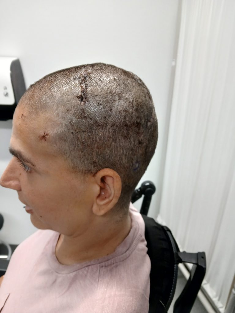 Audrey Crews Neuralink P9 Post-Surgery Unwrapped